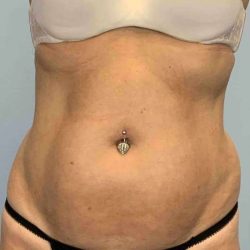 Renuvion Before & After Patient #10935
