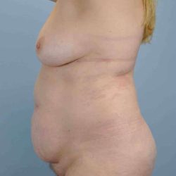 VASER Liposelection Before & After Patient #10384