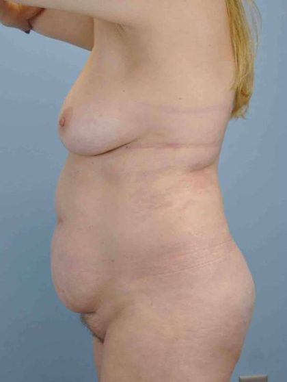 VASER Liposelection Before & After Patient #10384