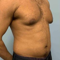 Renuvion Before & After Patient #10978
