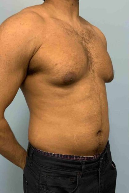 Renuvion Before & After Patient #10978