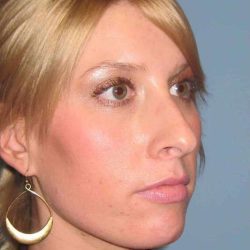 Nose Surgery Before & After Patient #10990