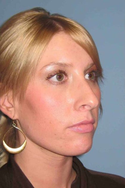 Nose Surgery Before & After Patient #10990