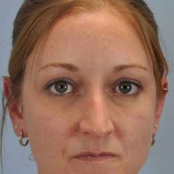 Nose Surgery Before & After Patient #10997