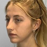 Nose Surgery Before & After Patient #11004