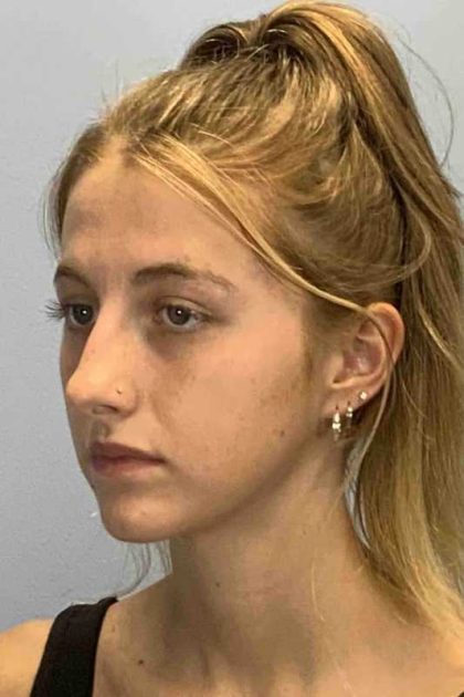 Nose Surgery Before & After Patient #11004