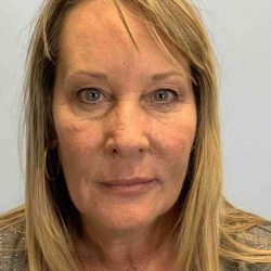 Nose Surgery Before & After Patient #11018
