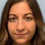 Nose Surgery Before & After Patient #11025