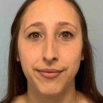 Nose Surgery Before & After Patient #11032