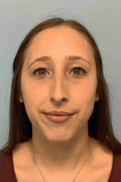 Nose Surgery Before & After Patient #11032