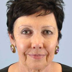 Neck Lift Before & After Patient #11039
