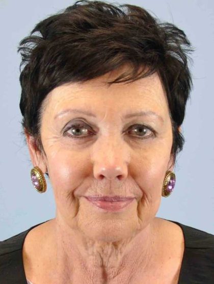 Neck Lift Before & After Patient #11039