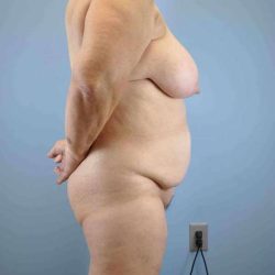 VASER Liposelection Before & After Patient #10377