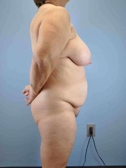 VASER Liposelection Before & After Patient #10377