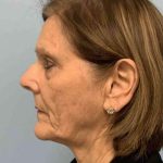 Neck Lift Before & After Patient #11053