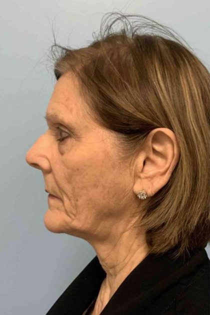 Neck Lift Before & After Patient #11053