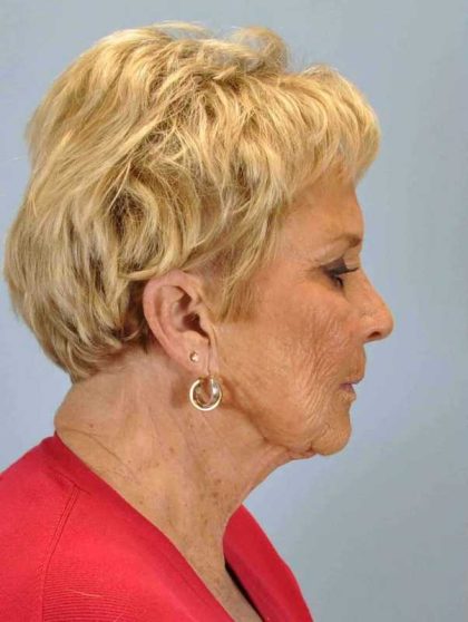 Neck Lift Before & After Patient #11069