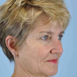 Neck Lift Before & After Patient #11076