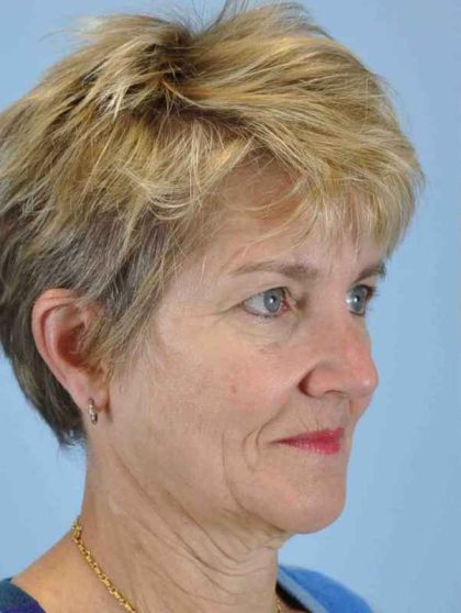 Neck Lift Before & After Patient #11076