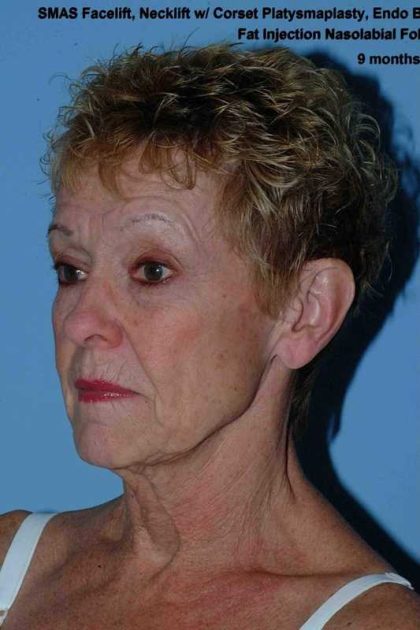 Neck Lift Before & After Patient #11111
