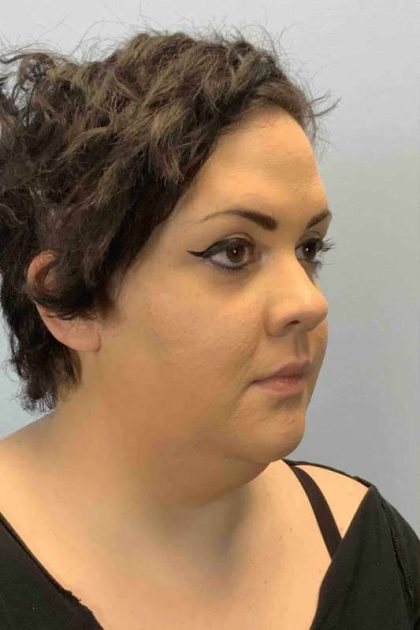 Neck Lift Before & After Patient #11120