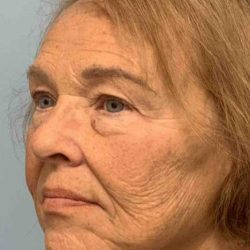 Neck Lift Before & After Patient #11127