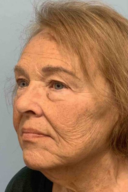 Neck Lift Before & After Patient #11127
