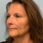 Neck Lift Before & After Patient #11134