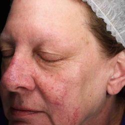 Laser Resurfacing Before & After Patient #11182