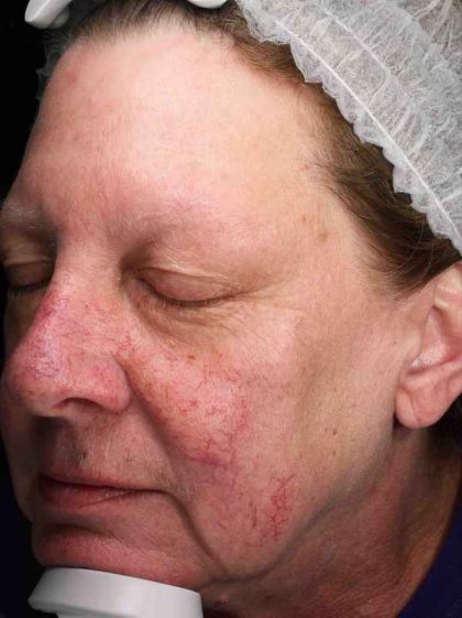 Laser Resurfacing Before & After Patient #11182
