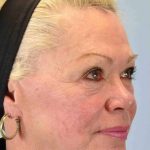 Laser Resurfacing Before & After Patient #11192