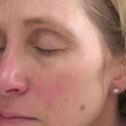 Laser Resurfacing Before & After Patient #11215