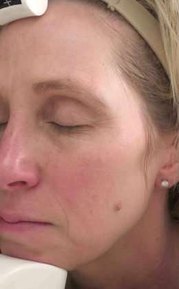 Laser Resurfacing Before & After Patient #11215