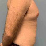 Gynecomastia Before & After Patient #11237