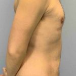 Gynecomastia Before & After Patient #11246