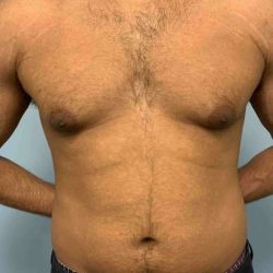 Gynecomastia Before & After Patient #11253