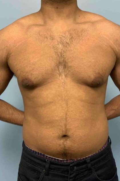 Gynecomastia Before & After Patient #11253