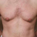 Gynecomastia Before & After Patient #11260