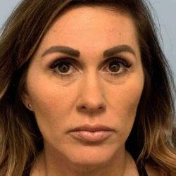 Fillers Before & After Patient #11283