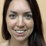 Fillers Before & After Patient #11298