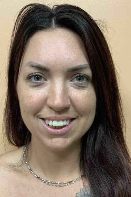 Fillers Before & After Patient #11298