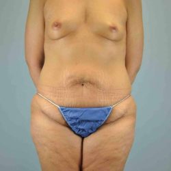 Fat Injections Before & After Patient #11333