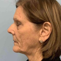 Fat Injections Before & After Patient #11347