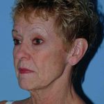 Facelift Before & After Patient #11364