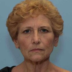 Facelift Before & After Patient #11371