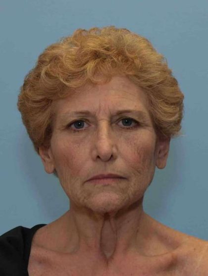 Facelift Before & After Patient #11371