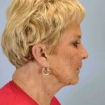 Facelift Before & After Patient #11380