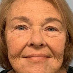 Facelift Before & After Patient #11410