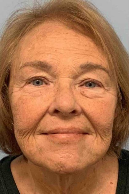Facelift Before & After Patient #11410