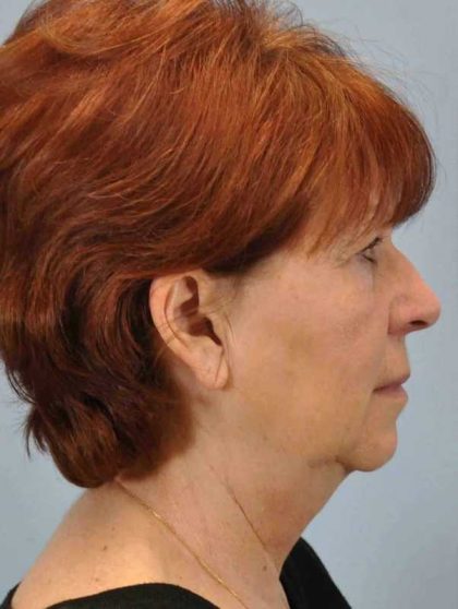 Facelift Before & After Patient #11417